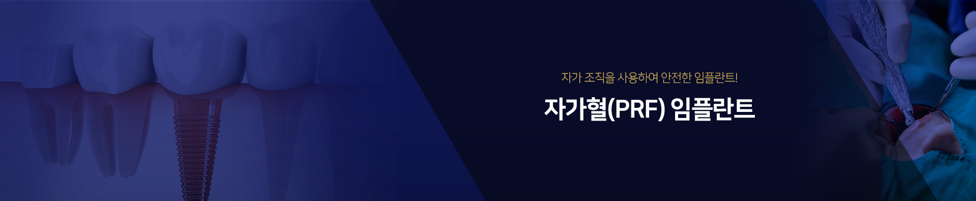 자가-조직을-사용하여-안정한-임플란트!
