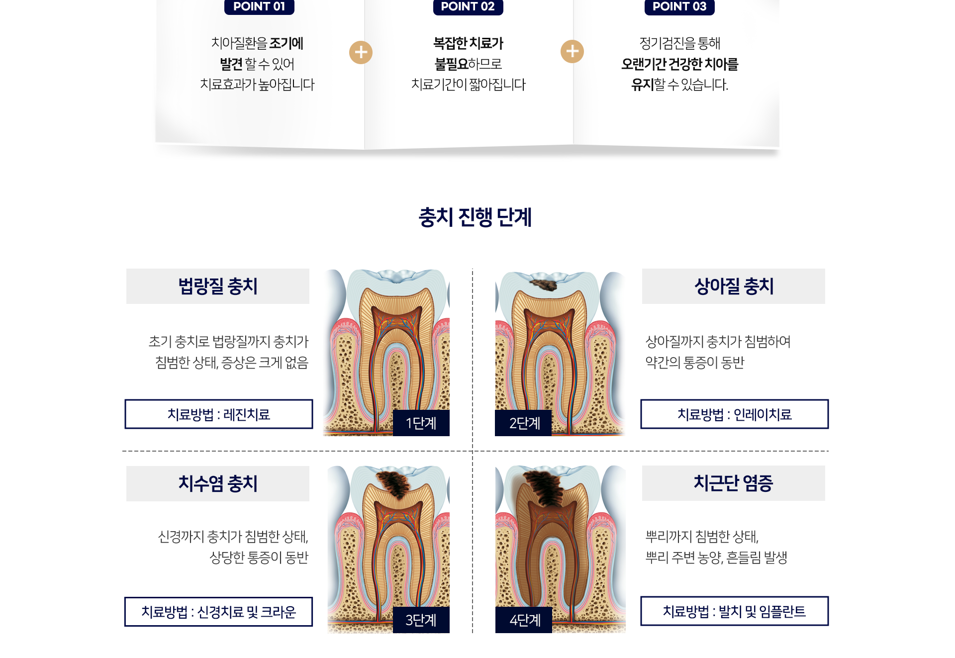 정기적인-치과검진-장점1-치아질환을-조기에-발견할-수-있어-치료-효과가-높아집니다-장점2-복잡한-치료가-불필요하므로-치료-기간이-짧아집니다-장점3-정기검진을-통해-오랜-기간-건강한-치아를-유지할-수-있습니다-충치-진행-단계-1단계-법랑질-충치-초기-충치로-법랑질까지-충치가-침범한-상태,-증상은-크게-없음-2단계-상아질-충치-상아질까지-충치가-침범하여-약간의-통증이-동반-3단계-치수염-충치-신경까지-충치가-침범한-상태,-상당한-통증이-동반-4단계-치근단-염증-뿌리까지-침범한-상태,-뿌리-주변-농양,-흔들림-발생