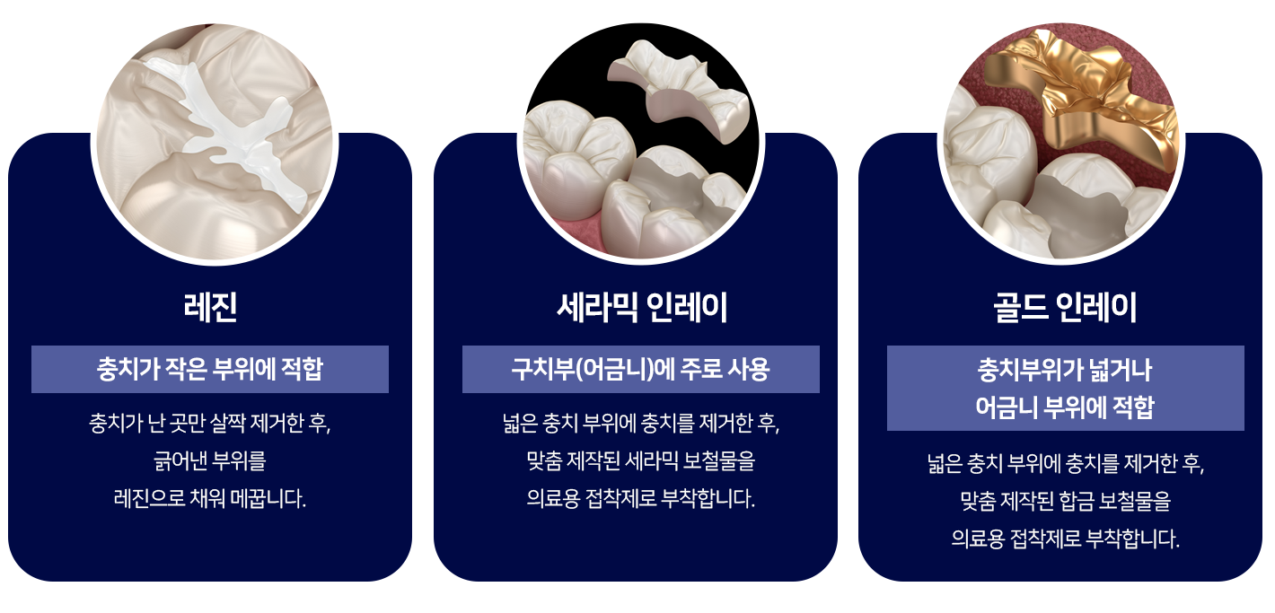 레진-충치가-작은-부위에-적합-충치가-난-곳만-살짝-제거한-후,-긁어낸-부위를-레진을-채워-메꿉니다-세라믹-인레이-구치부_어금니에-주로-사용-넓은-충치-부위에-충치를-제거한-후,-맞춤-제작된-세라믹-보철물을-의료용-접착제로-부착합니다-골드-인레이-충치-부위가-넓거나-어금니-부위에-적합-넓은-충치-부위에-충치를-제거한-후,-맞춤-제작된-합금-보철물을-의료용-접착제로-부착합니다