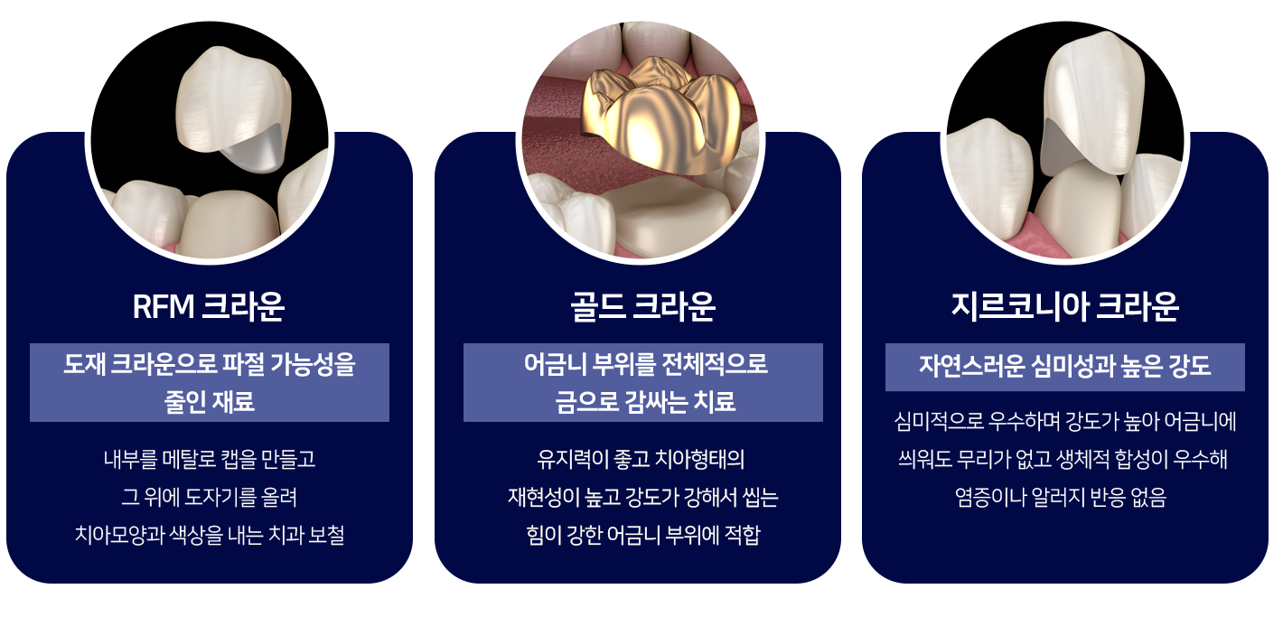 RFM-크라운-도재-크라운으로-파절-가능성을-줄인-재료-내부를-메탈로-캡을-만들고-그-위에-도자기를-올려-치아-모양과-색상을-내는-치과-보철-골드-크라운-어금니-부위를-전체적으로-금으로-감싸는-치료-유지력이-좋고-치아-형태의-재현성이-높고-강도가-강해서-씹는-힘이-강한-어금니-부위에-적합-지르코니아-크라운-자연스러운-심미성과-높은-강도-심미적으로-우수하며-강도가-높아-어금니에-씌워도-무리가-없고-생체적-합성이-우수해-염증이나-알러지-반응-없음