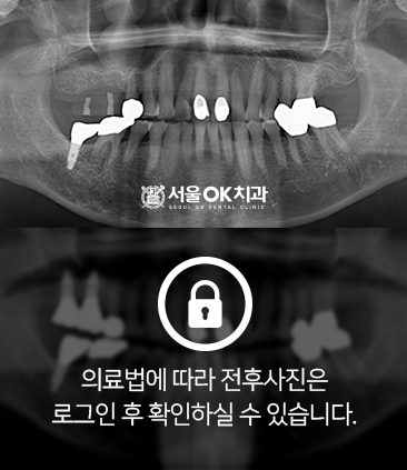 임플란트-전후사진5