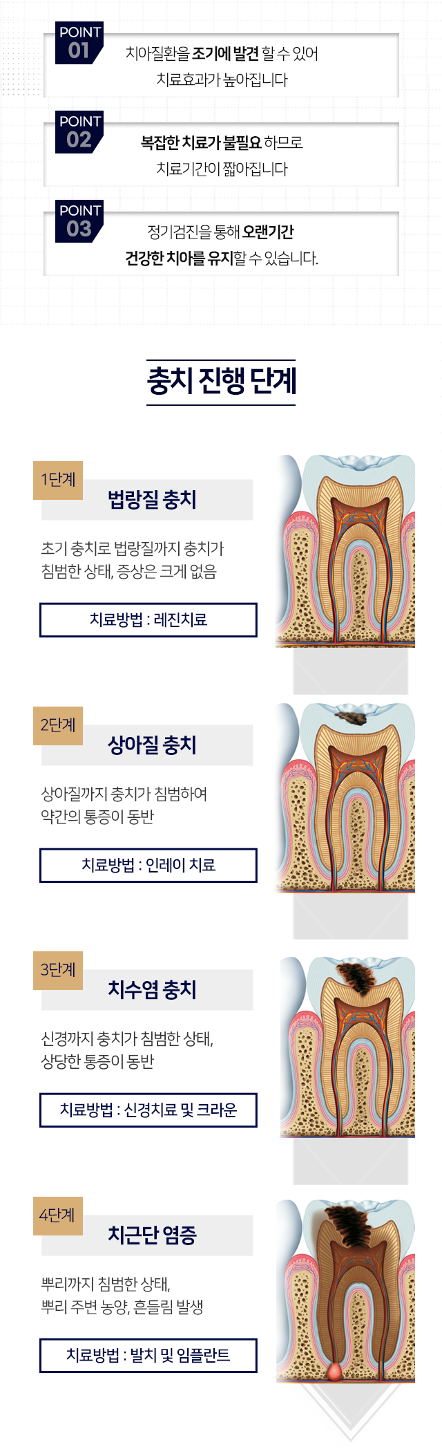 정기적인-치과검진-장점1-치아질환을-조기에-발견할-수-있어-치료-효과가-높아집니다-장점2-복잡한-치료가-불필요하므로-치료-기간이-짧아집니다-장점3-정기검진을-통해-오랜-기간-건강한-치아를-유지할-수-있습니다-충치-진행-단계-1단계-법랑질-충치-초기-충치로-법랑질까지-충치가-침범한-상태,-증상은-크게-없음-2단계-상아질-충치-상아질까지-충치가-침범하여-약간의-통증이-동반-3단계-치수염-충치-신경까지-충치가-침범한-상태,-상당한-통증이-동반-4단계-치근단-염증-뿌리까지-침범한-상태,-뿌리-주변-농양,-흔들림-발생