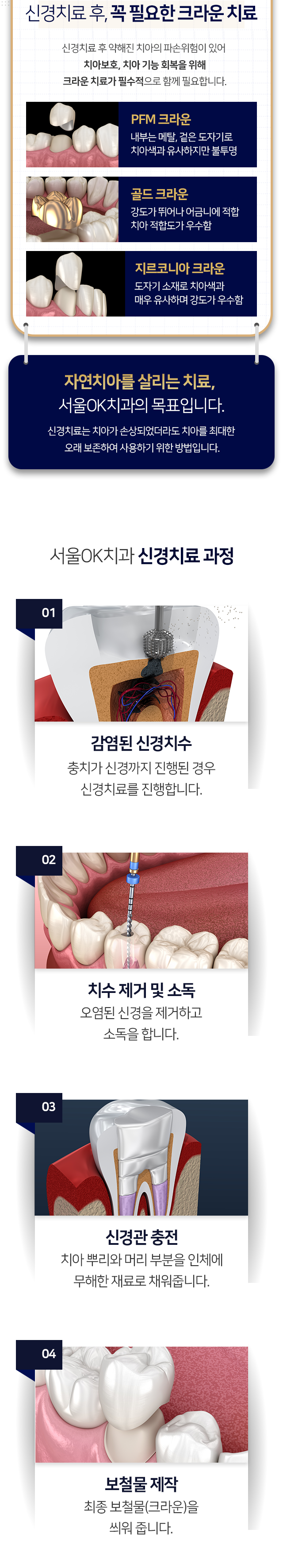 신경치료-후-약해진-치아의-파손-위험이-있어-치아보호,-치아-기능-회복을-위해-크라운-치료가-필수적으로-함께-필요합니다-신경치료-과정-1단계-감염된-신경-치수-충치가-신경까지-진행된-경우-신경치료를-진행합니다-2단계-치수-제거-및-소독-오염된-신경을-제거하고-소독을-합니다-3단계-신경관-충전-치아-뿌리와-머리-부분을-인체에-무해한-재료로-채워줍니다-4단계-보철물-제작-최종-보철물_크라운을-씌워줍니다