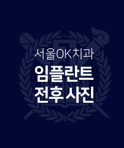 임플란트-전후-사진