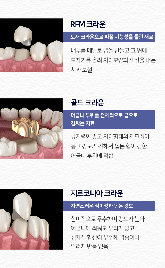 RFM-크라운-도재-크라운으로-파절-가능성을-줄인-재료-내부를-메탈로-캡을-만들고-그-위에-도자기를-올려-치아-모양과-색상을-내는-치과-보철-골드-크라운-어금니-부위를-전체적으로-금으로-감싸는-치료-유지력이-좋고-치아-형태의-재현성이-높고-강도가-강해서-씹는-힘이-강한-어금니-부위에-적합-지르코니아-크라운-자연스러운-심미성과-높은-강도-심미적으로-우수하며-강도가-높아-어금니에-씌워도-무리가-없고-생체적-합성이-우수해-염증이나-알러지-반응-없음