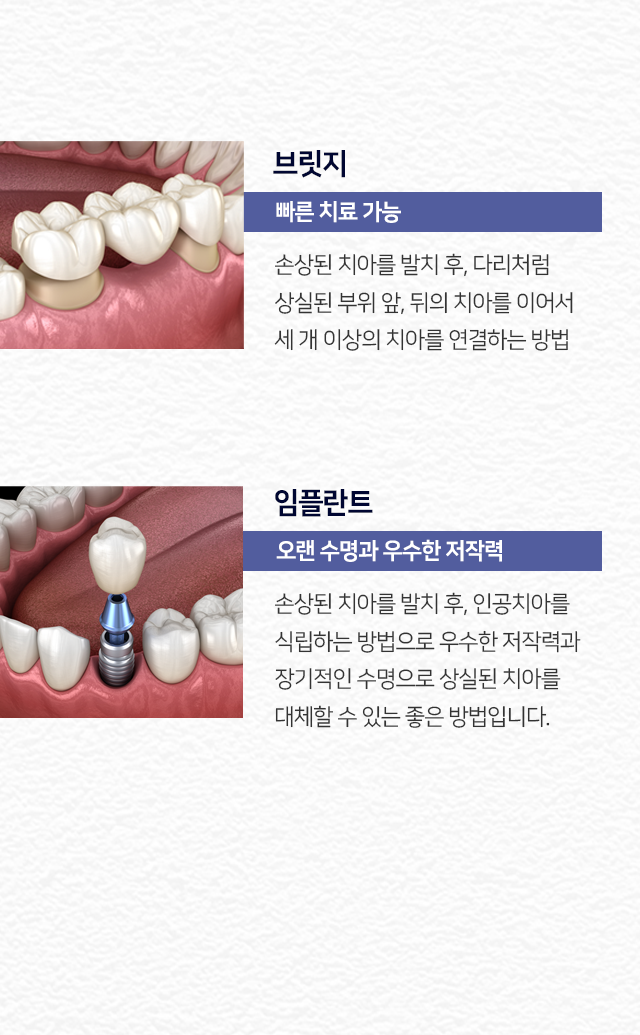 브릿지-빠른-치료-가능-손상된-치아를-발치-후,-다리처럼-상실된-부위-앞뒤의-치아를-이어서-세-개-이상의-치아를-연결하는-방법-임플란트-오랜-수명과-우수한-저작력-손상된-치아를-발치-후,-인공치아를-식립하는-방법으로-우수한-저작력과-장기적인-수명으로-상실된-치아를-대체할-수-있는-좋은-방법입니다